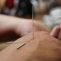 Klets&Baby: Acupunctuur